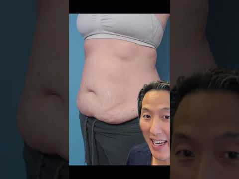 Tummy Tuck REVEAL! #shorts #tummytuck