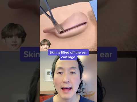 Watch How Ear Pinning (Otoplasty) Surgery Works! #shorts #otoplasty