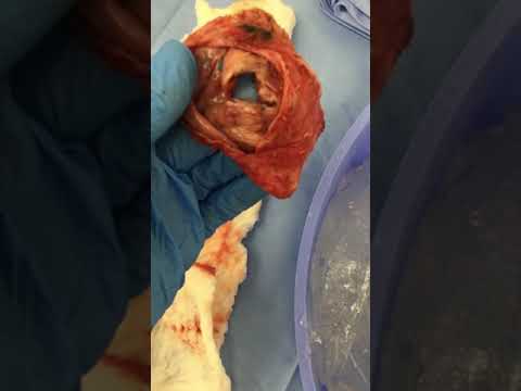 What I Removed From My Patient This Morning #shorts #breastimplants